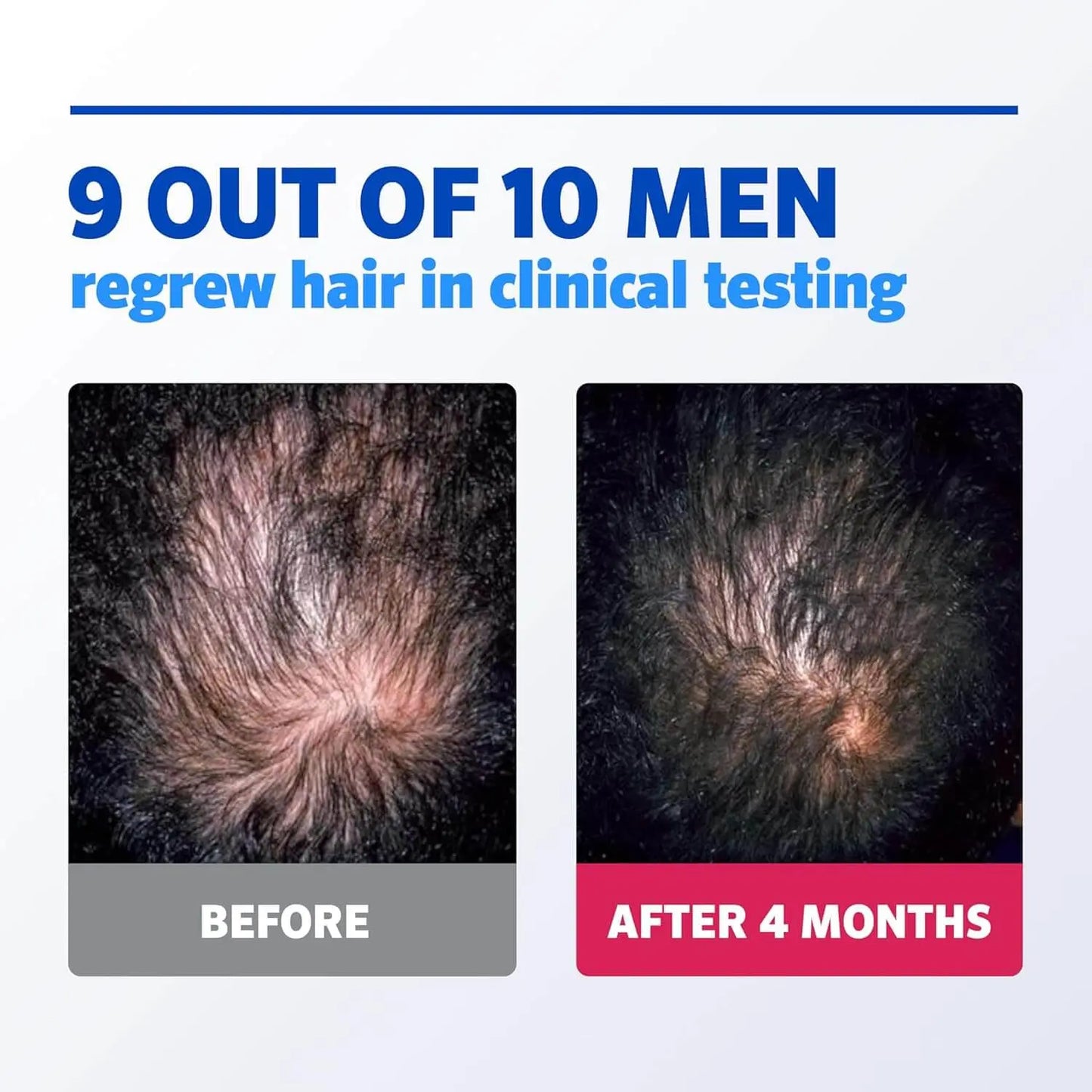 Before and after hair regrowth treatment showing results on a white background.